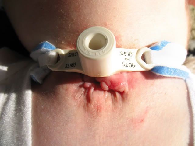 infected under the flange