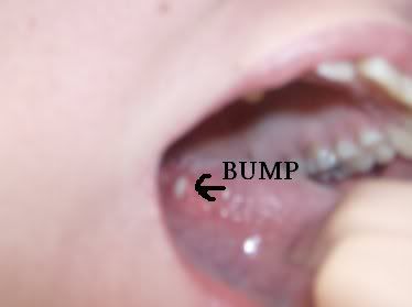 I Have A Small White Patch On My Tongue