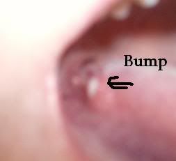 Lump Under Tongue