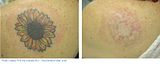 Find Tattoo Removal