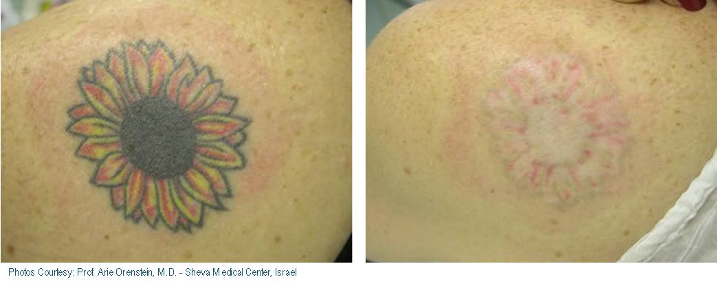 tattoo ink removal. Color Tattoo Removal Laser