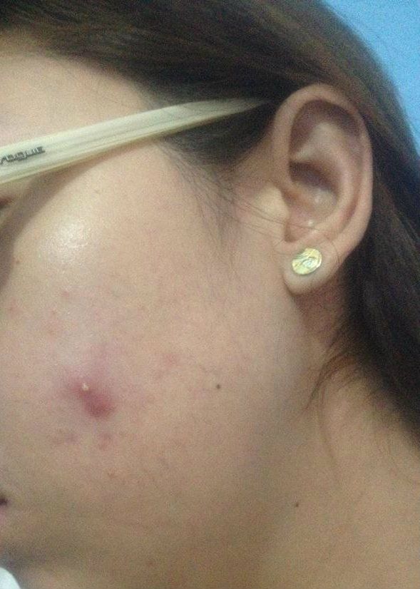 Cyst Cheek