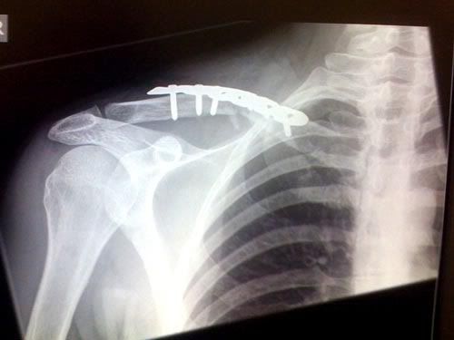 cycle injury clavicle broken collar bone