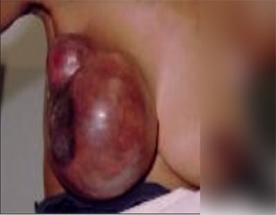 breast_cancer-1.jpg